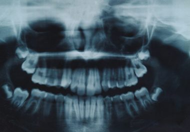 What-to-expect-from-your-wisdom-teeth-removal