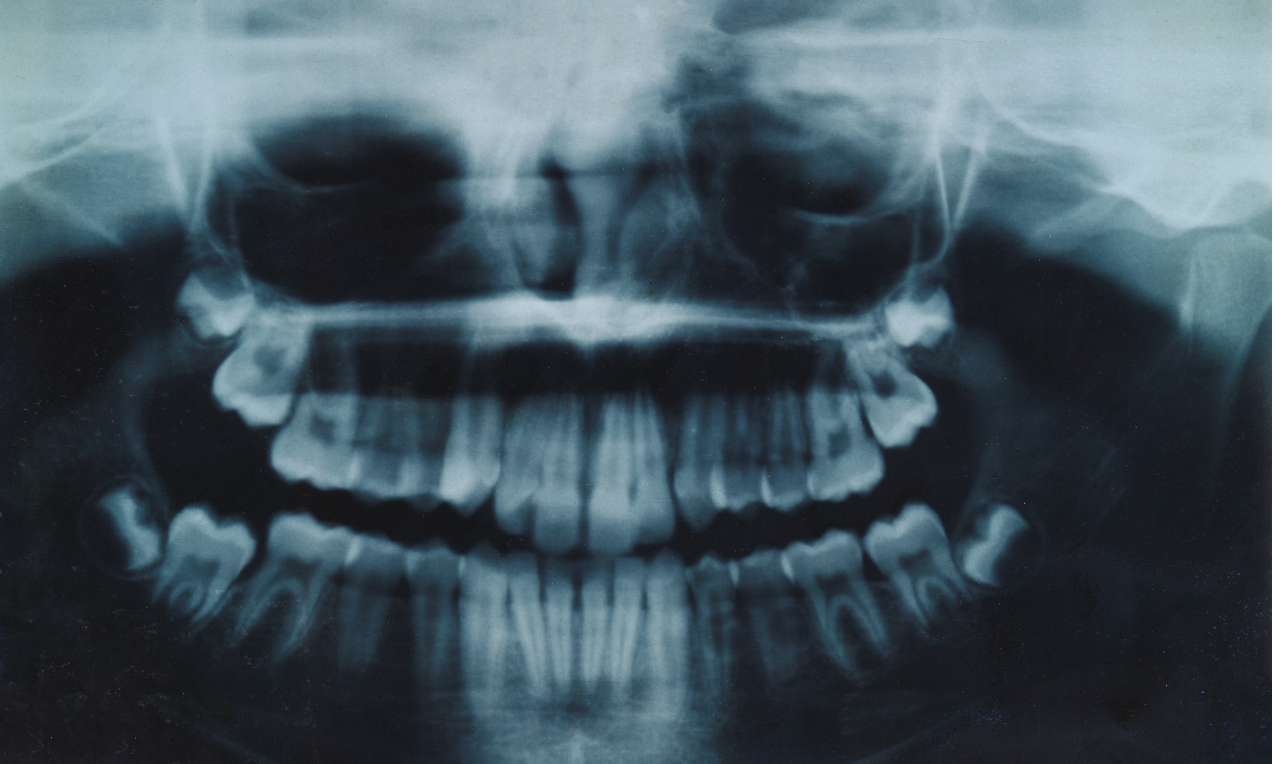 What To Expect From Your Wisdom Teeth Removal